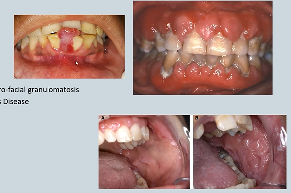 <ol><li><p>Gingival Hyperplasia </p><ul><li><p>Nifedipine ,Cyclosporin ,Phenytoin, <strong>Leukaemias </strong></p></li></ul></li><li><p>Lip swelling </p><ul><li><p>Crohn’s Disease / Oro-facial granulomatosis (few years later affects the get)</p></li></ul></li><li><p>Cobble stoning – Crohn’s Disease - t<mark data-color="#deffdf" style="background-color: rgb(222, 255, 223); color: inherit;">rauma, endoscopy </mark></p></li><li><p>Pregnancy - epulis</p></li></ol><p></p>