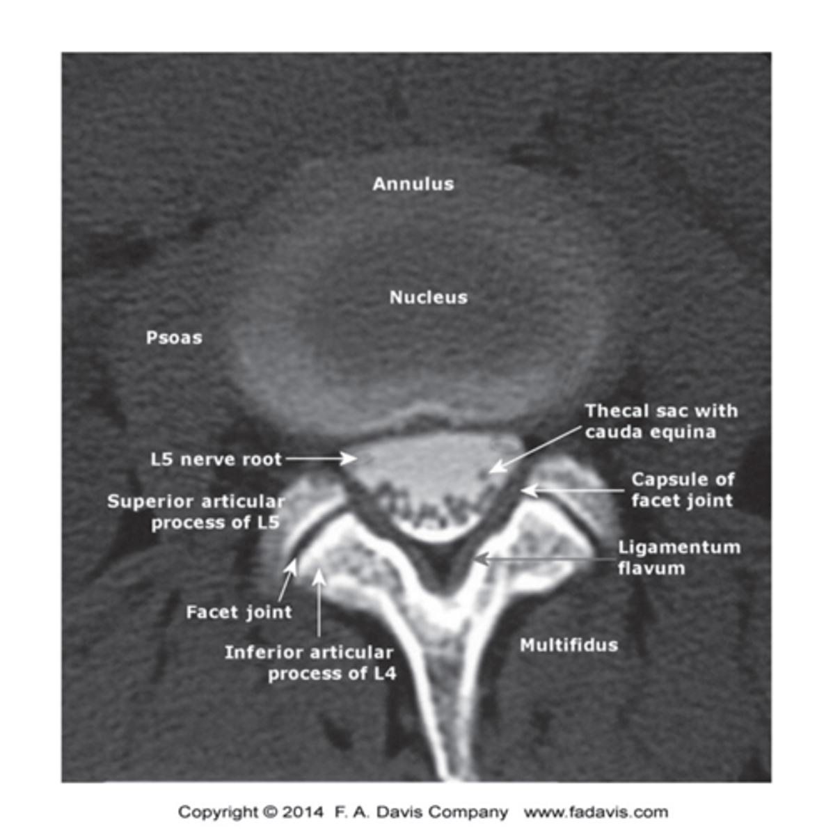 <p>- It is a high radiation exposure relative to most conventional radiographic exams</p><p>- Has less soft tissue contrast than MRI</p><p>- Is possible to have static versus dynamic examinations with diagnostic ultrasound</p>