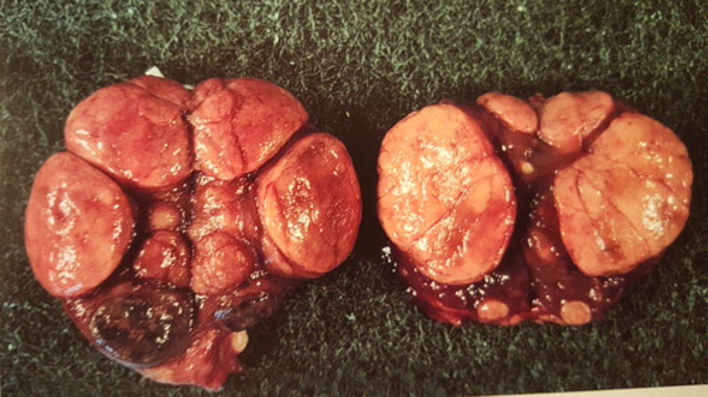 <p>Gl. thyroidea fra hest. Patoanatomisk diagnose?</p>