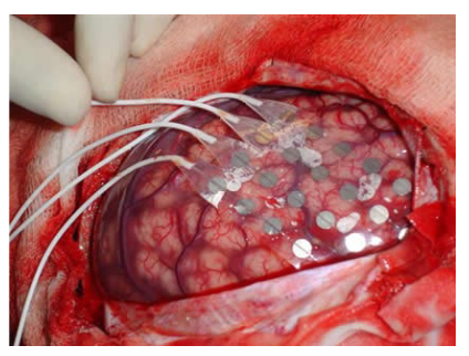 <p>Cutting skull open and putting electrodes straight onto the cerebral cortex. </p>