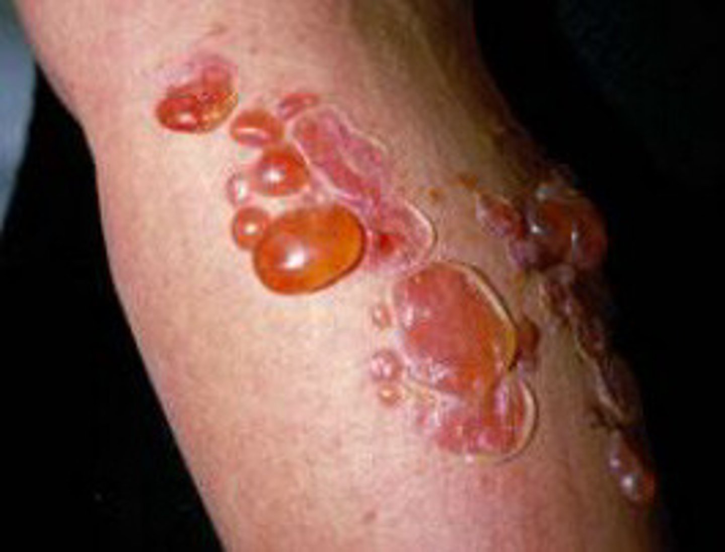 <p>Bullous impetigo</p>