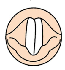 What type of VF closure is this?