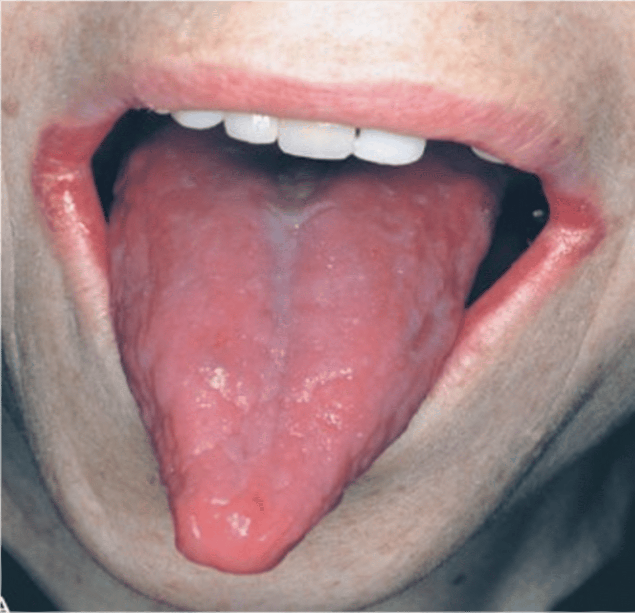 <p>lack of mature erythrocytes caused by inability to absorb vitamin B12 into the bloodstream</p>