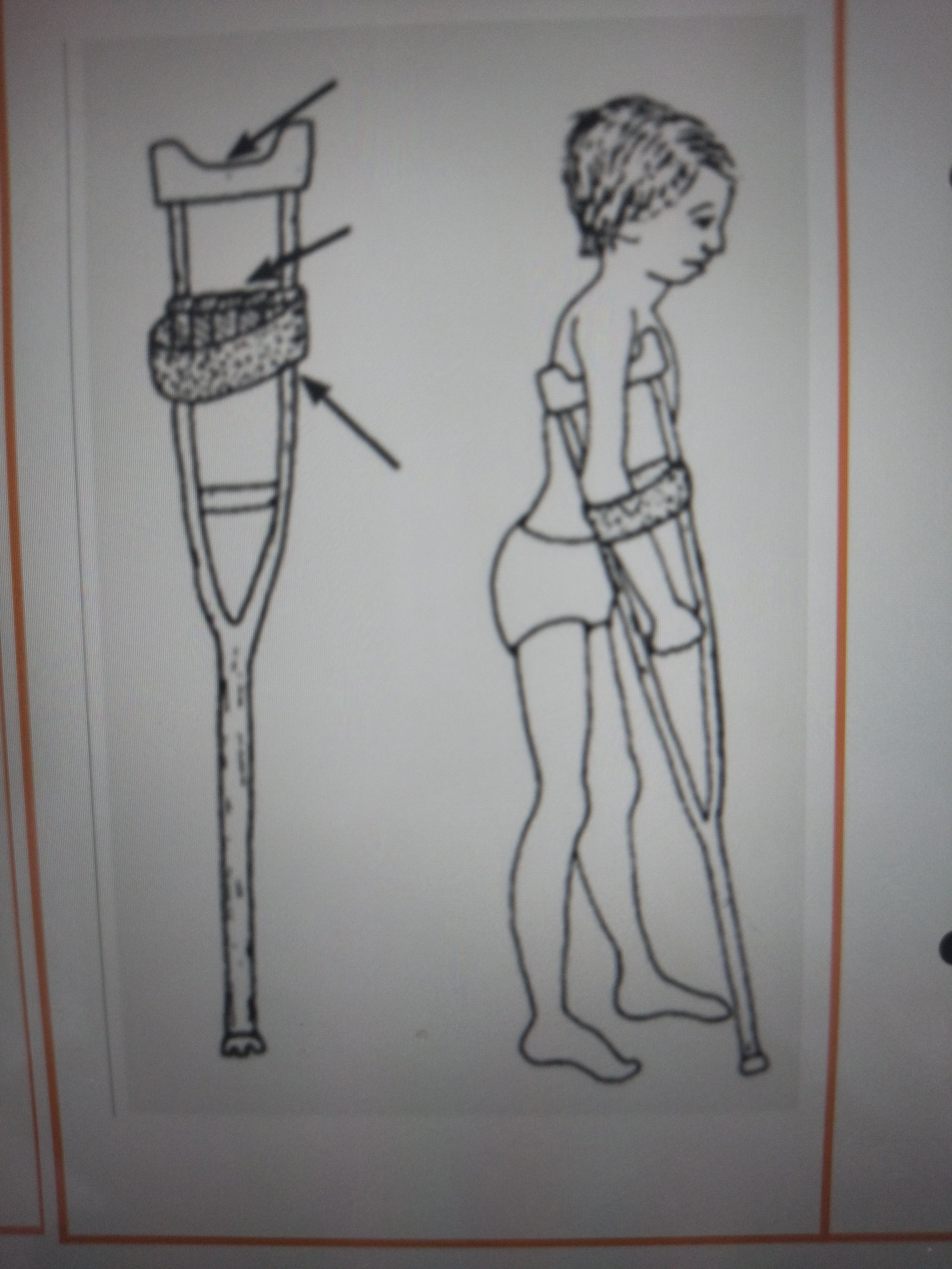 * Aka arm orthosis/right triceps weakness crutches
* They resemble axillary crutches but proximally has cuff on mid-arm level/mid-arm humerus 
* originally developed for patients with polio and it is rarely prescribed
* They prevent flexion or buckling of elbow during gait, hence the cuff