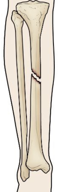occurs at an angle across the bone
