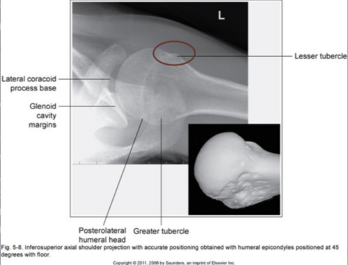 <p>In profile anteriorly</p>