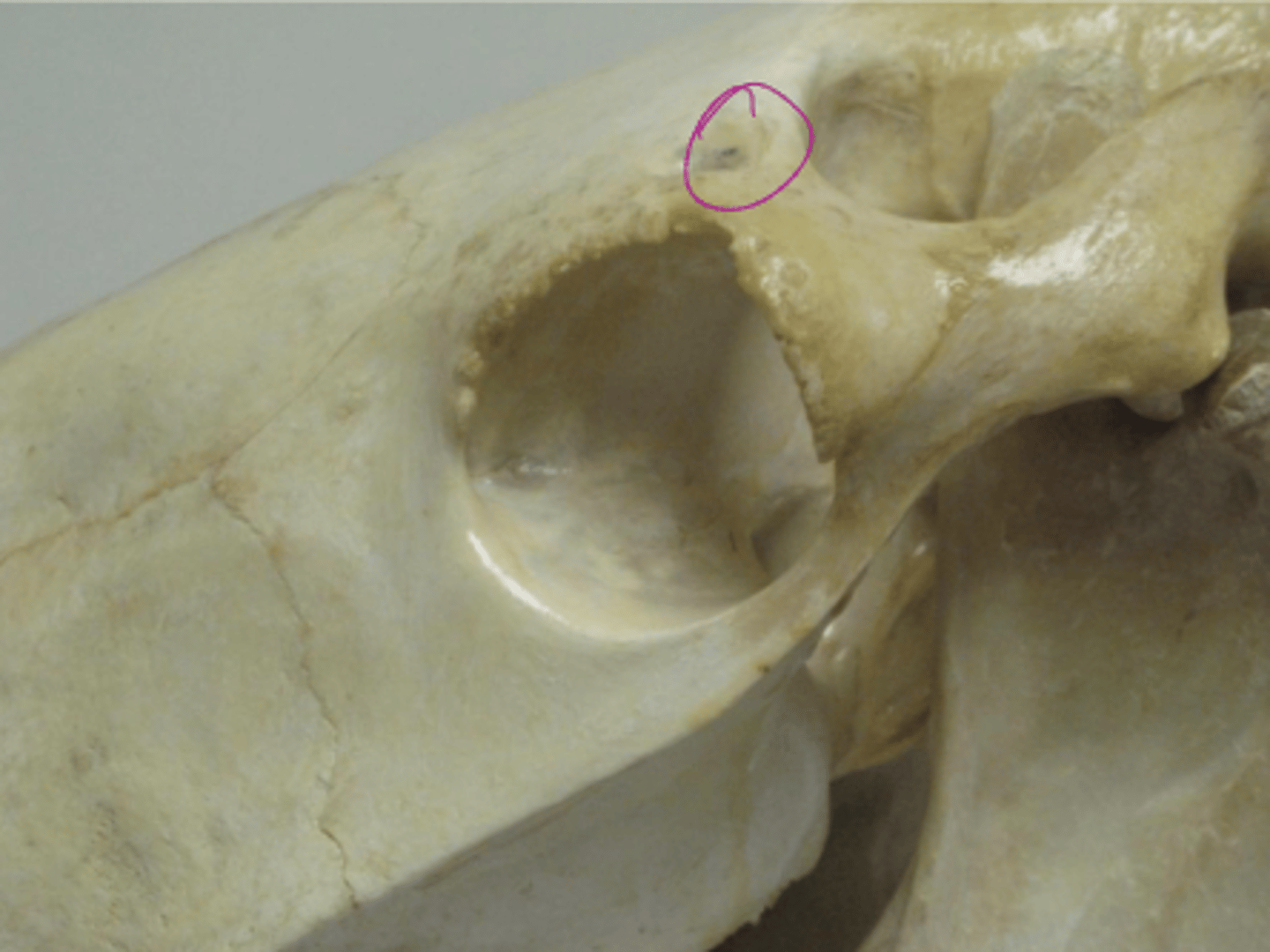 <p>-palp orbital ring</p><p>-and pinch over narrowest portion index finger will fall onto the  supraorbital foramen</p><p>-anaesthetic to upper eyelid</p>