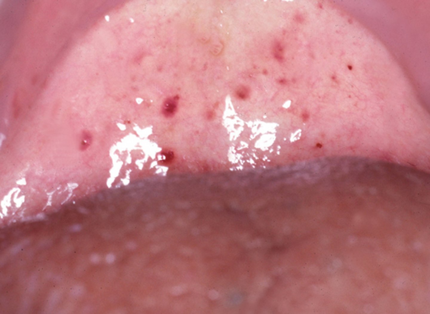 <p>A lesion measures approximately 5 mm, appear red-purple, and does not blanch on pressure.</p><p>What is the most likely diagnosis?</p>