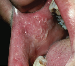 <p>lesions caused by chronic chewing of the mucosa</p><p>usually <span style="color: red;">habit or stress induced</span>, occur in children or adults</p><ul><li><p><strong>clinical considerations</strong></p><ul><li><p>problematic for CD patients</p></li><li><p>causes problems in vertical dimension</p></li></ul></li></ul><p></p>