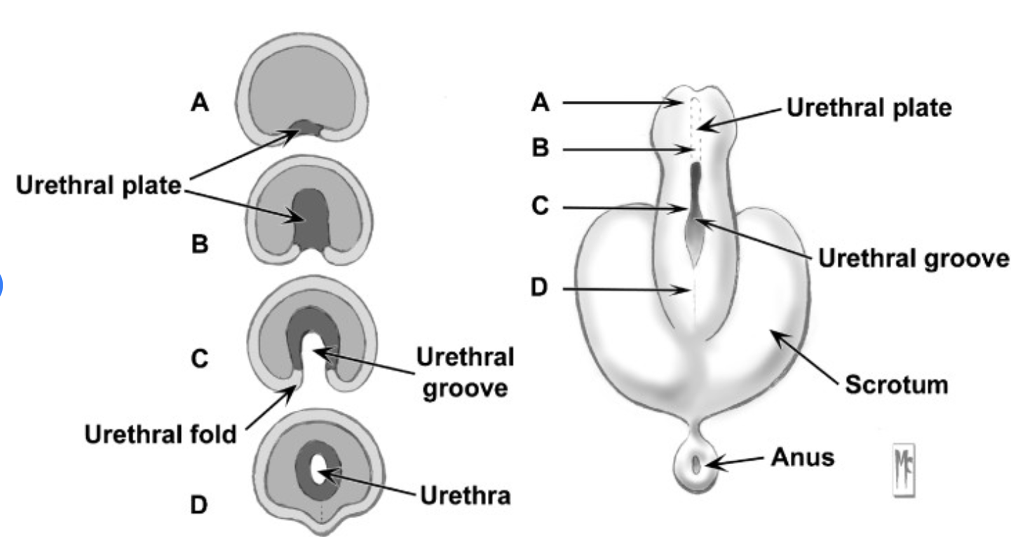 <ul><li><p>urogenital fold fail to fuse </p></li><li><p>penile urethra doesn’t develop completely </p></li></ul><p></p>