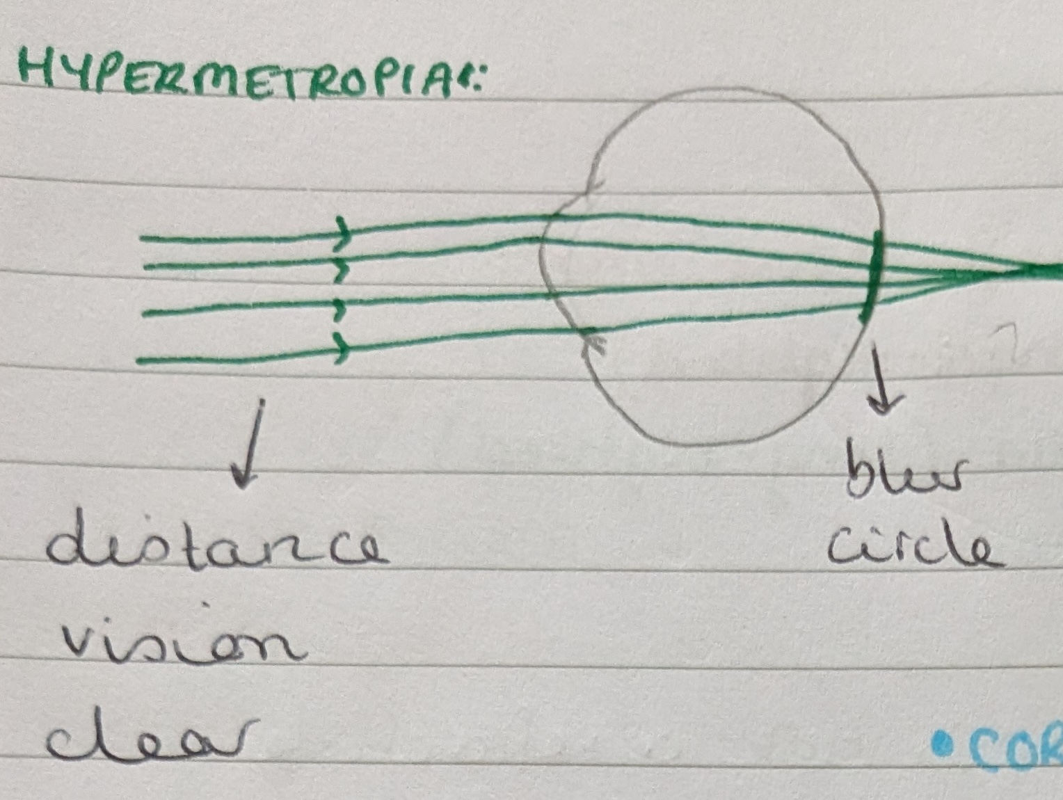 <p>Axial hypermetropia, which is caused by the eye being too short. </p><p>Refractive hypermetropia, which is caused by either the cornea or the lens being too flat or too weak. </p><p>This results in the image being formed behind the retina. </p><p>In hypermetropia, distance vision is clear while near vision is blurred. </p>