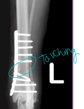 <p><span style="background-color: transparent;"><strong>Direct (Primary) Bone Healing</strong></span></p>