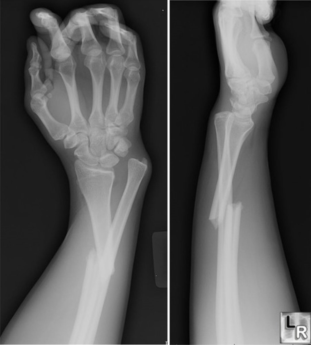 <p>fracture of radial shaft</p><p>- oblique/transverse Fx</p><p>dislocation of the distal radioulnar joint</p>