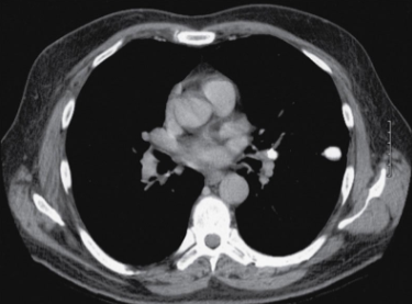 <p>Solitary pulmonary nodule</p>