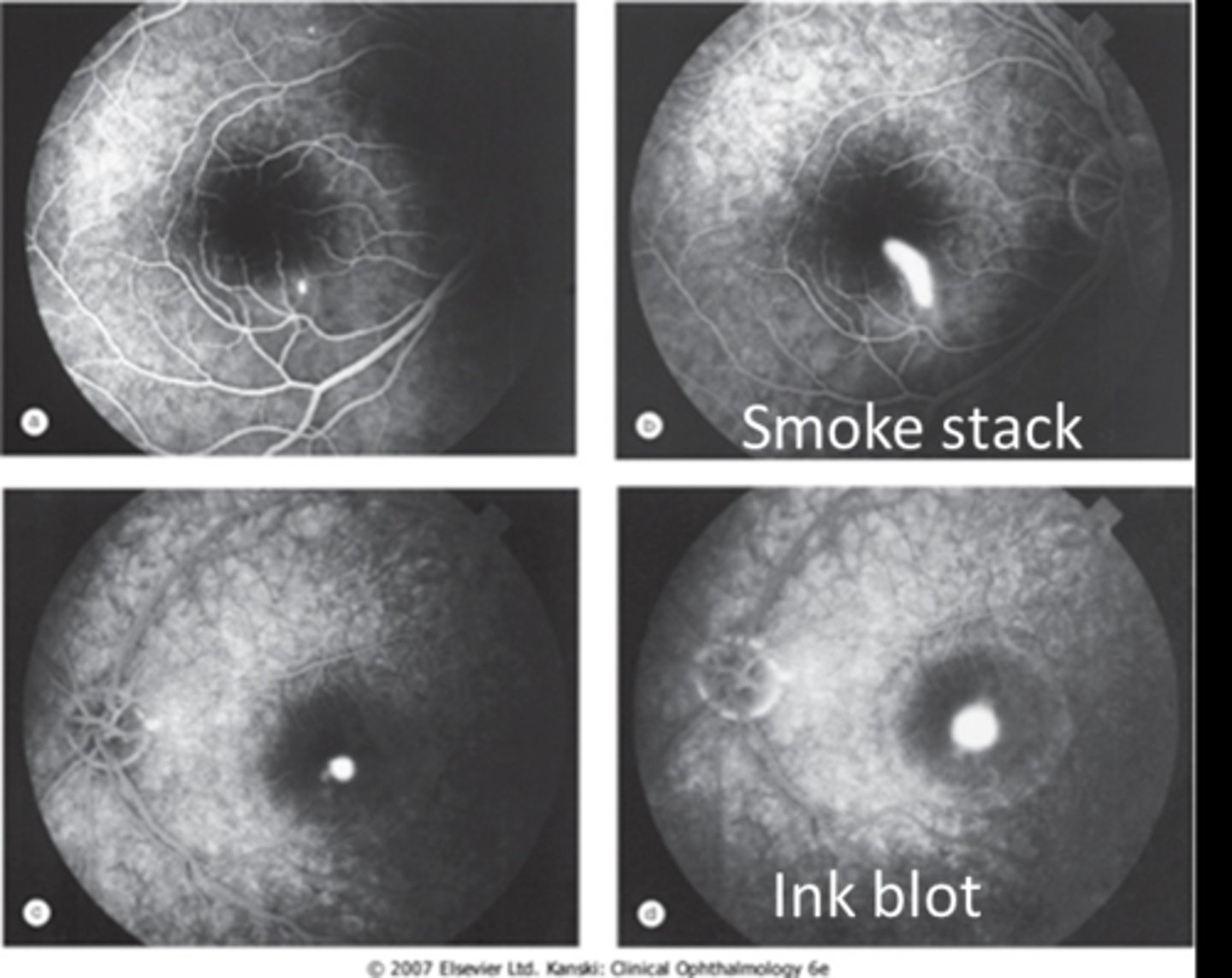 <p>early = hyperF spot at RPE defect</p><p>late = fluid enters through RPE and leaks/pools in either a smoke stack or ink blot pattern</p>