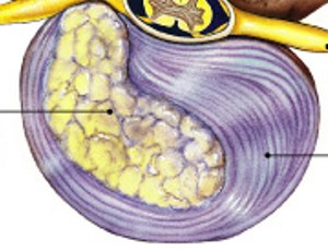 <p>Which type of damage to the intervertebral discs has:</p><ul><li><p>Nuclear pulposus breaks through annular fibers</p></li><li><p>Presses on spinal cord or spinal nerves</p></li><li><p>Prolapse</p></li></ul><p></p>