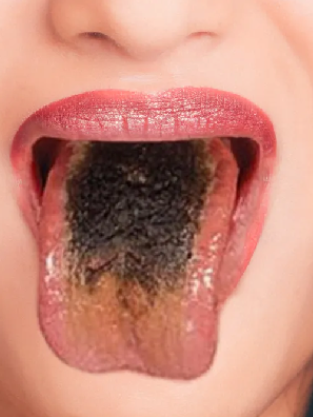 <p>a condition in which the<span style="color: red;"><span> filiform papillae</span></span> become markedly long, resulting in an appearance like a<span style="color: red;"><span> long-tufted carpet</span></span></p><ul><li><p><strong>causes of discoloration</strong></p><ul><li><p>the<span style="color: red;"><span> long filiform papillae may trap chromogenic bacteria</span></span>, fungi, and<span style="color: red;"><span> food pigmentations</span></span></p></li><li><p>this can give the tongue various colors: white, brown, or black</p></li></ul></li><li><p><strong>management:</strong></p><ul><li><p><span style="color: red;">brushing the tongue</span> with a toothbrush or using a <span style="color: red;">tongue scraper</span> will usually eliminate the discoloration </p></li></ul></li></ul><p></p>