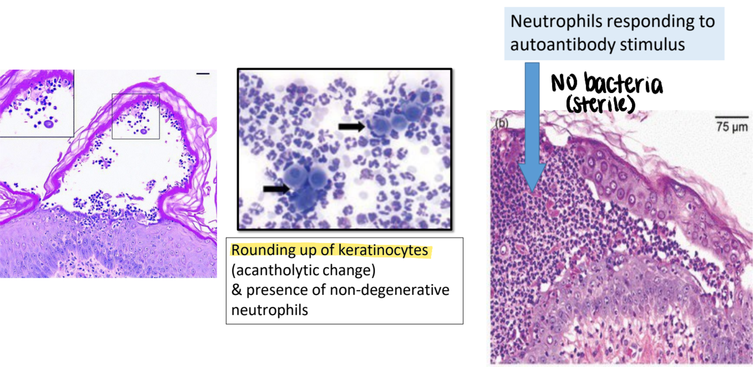 <ul><li><p><strong>autoantibodies directed against desmosomes</strong> (extracellular cement protein of epidermis; anchors epidermal cells)</p></li><li><p><strong>neutrophils respond to autoantibody stimulus but no bacteria</strong></p></li><li><p>rounding up of keratinocytes (acantholytic change) &amp; presence of non-degenerative neutrophils</p></li></ul><p></p>