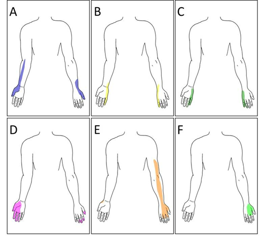 <p>Student Doctors – UL nerve injuries are high yield on COMLEX &amp; USMLE!</p><p>Guess the lesion/etiology from patterns of sensory loss.</p><p>See the figure and the clues below. Answers at the bottom!</p><p>Pt A: 50-year-old male with neck pain</p><p>Pt B: 55-year-old male with hand weakness</p><p>Pt C: 22-year-old female after falling from her bicycle</p><p>Pt D: 24-year-old female after motor vehicle accident</p><p>Pt E: 17-year-old male with sharp force penetrating trauma to right UL</p><p>Pt F: 30-year-old female after external fixation of forearm fracture</p>