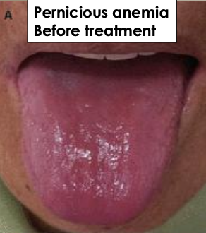 <p>What are the general symptoms of anemia?</p>