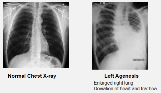 <ul><li><p>complete absence of one or both lungs:</p><ul><li><p>can be just a lobe</p></li></ul></li><li><p>disruption of lung bud during formation</p></li></ul><p></p>