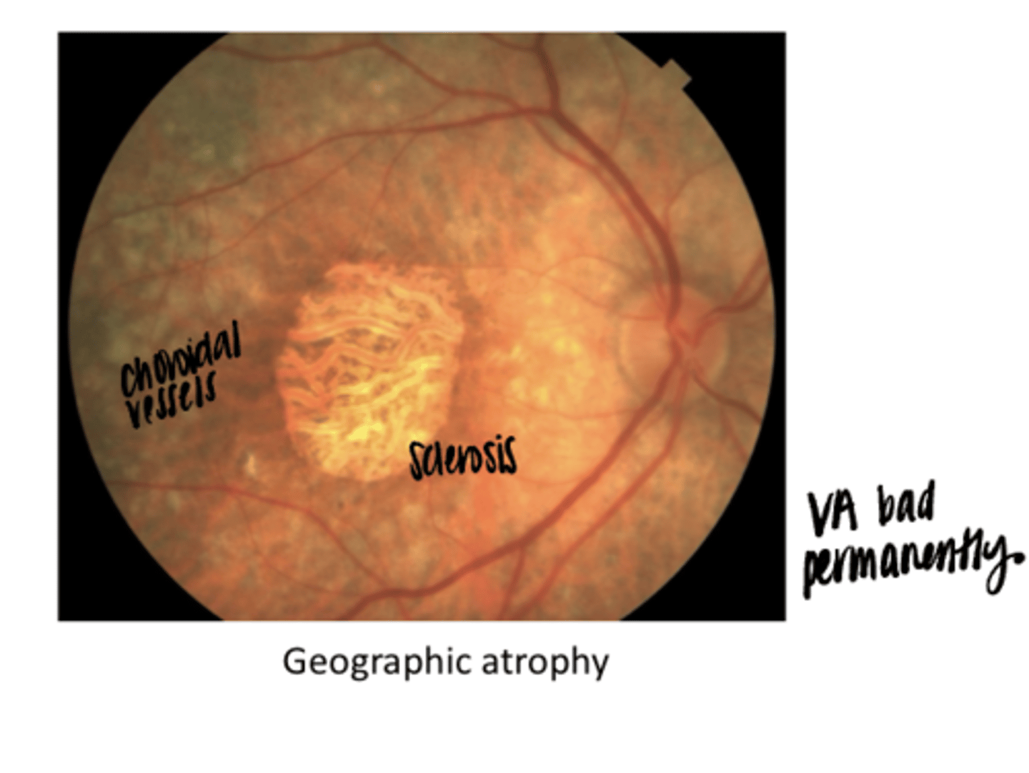 <p>Geographic Atophy -- Worse Case of Dry AMD (Pic)</p>
