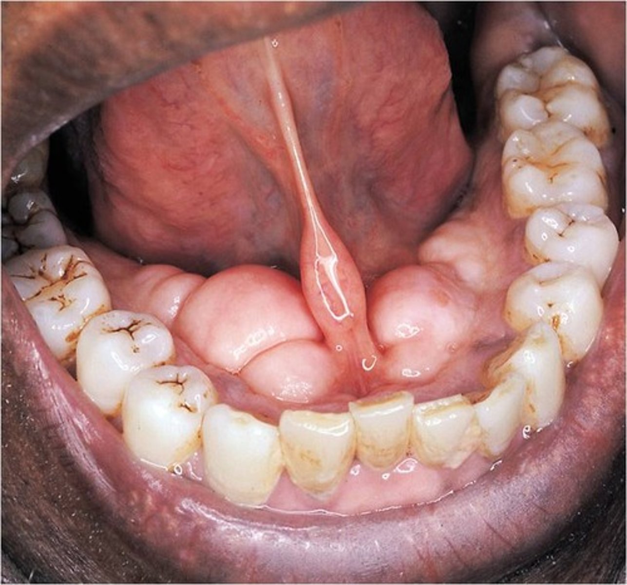 <p>-outgrowth of dense bone found on lingual aspect of the mandible in the premolar and mylohyoid ridge area</p><p>-usually bilateral</p><p>-often lobulated or nodular</p><p>-can appear fused</p><p>-no predilection for either sex</p>