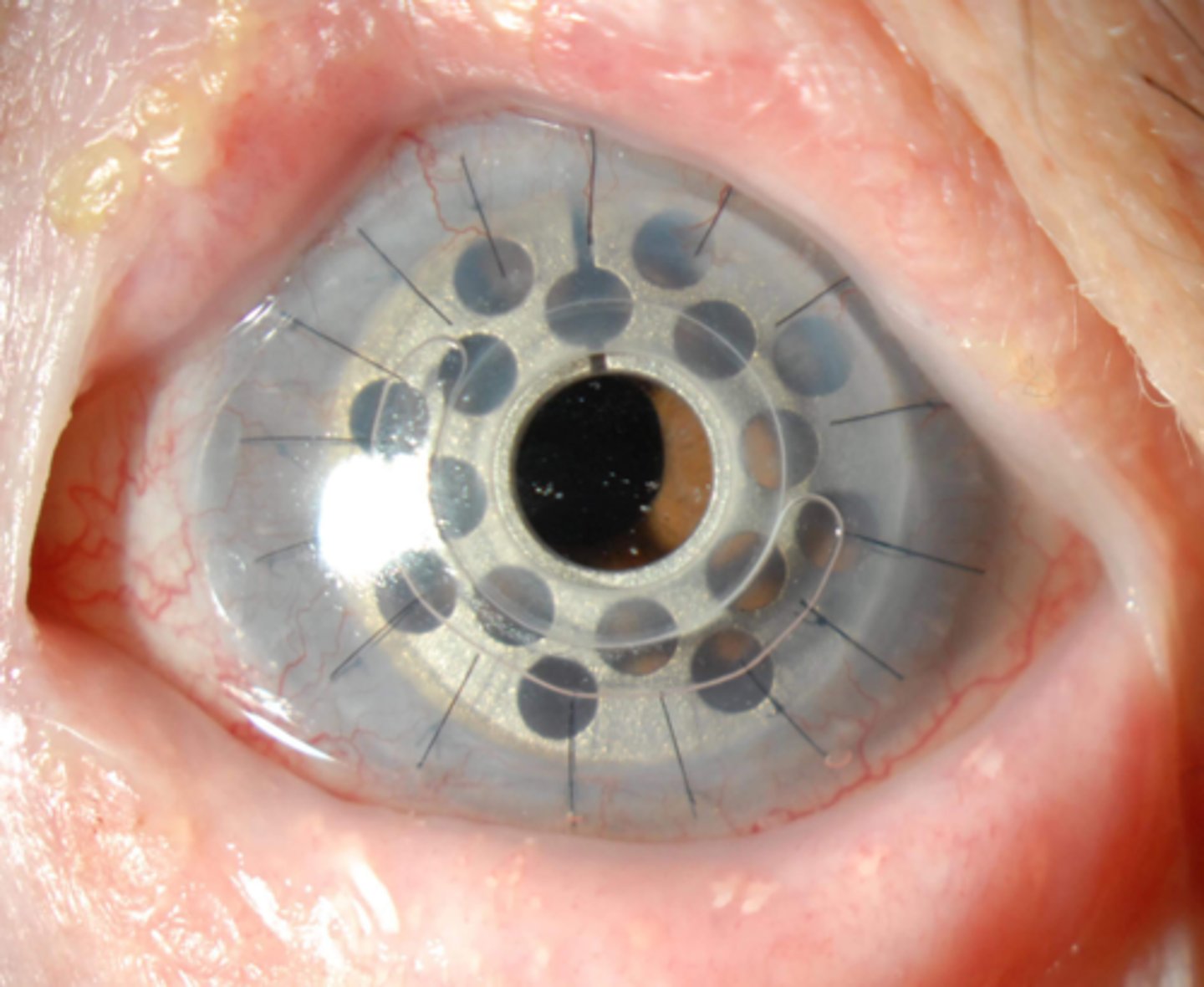 <p>True or False: the Boston K-Pro uses a donor corneal graft between the front optical stem and the back plate.</p>