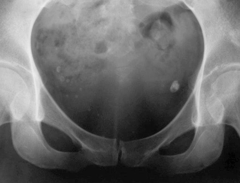 <p>calcification w/in pelvic venous system- no clinical significance</p>