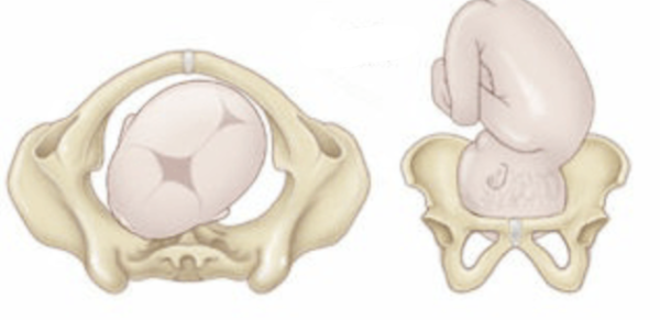<p>back of the baby’s head (occiput) is pointing toward the mother’s left front side</p><ul><li><p>Baby’s Face: the mother’s right back side</p></li><li><p>most common and <strong>ideal position for vaginal birth</strong></p></li></ul><p></p>