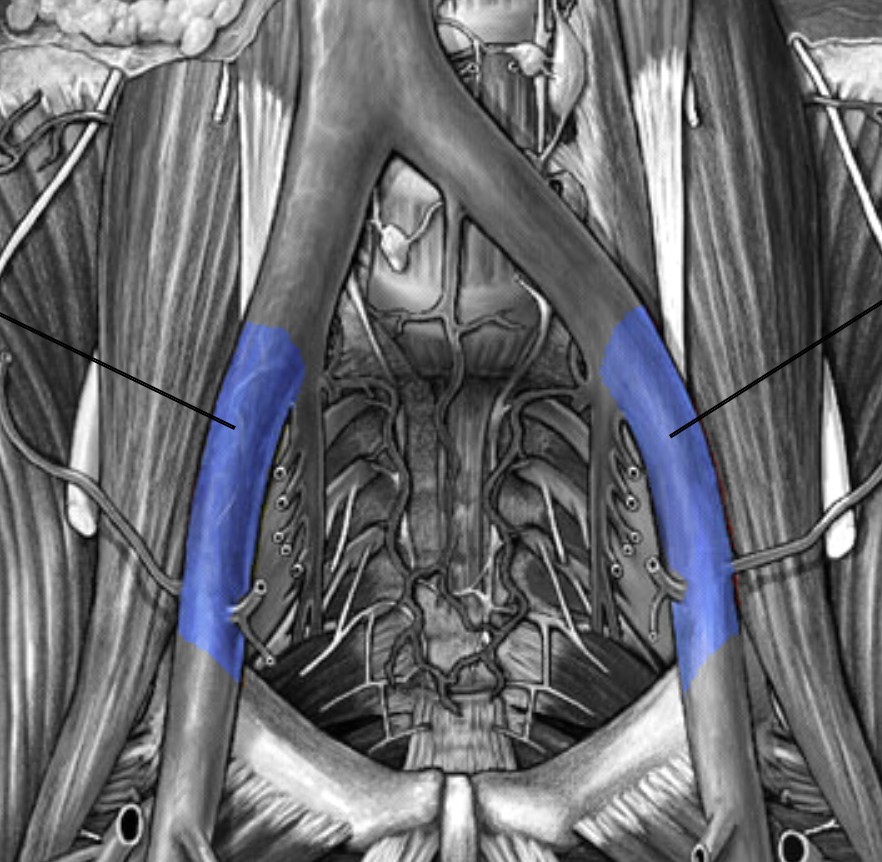 <p>Which veins:</p><ul><li><p>Inferior to common iliac vein</p></li><li><p>Lateral to internal iliac vein</p></li></ul><p></p>