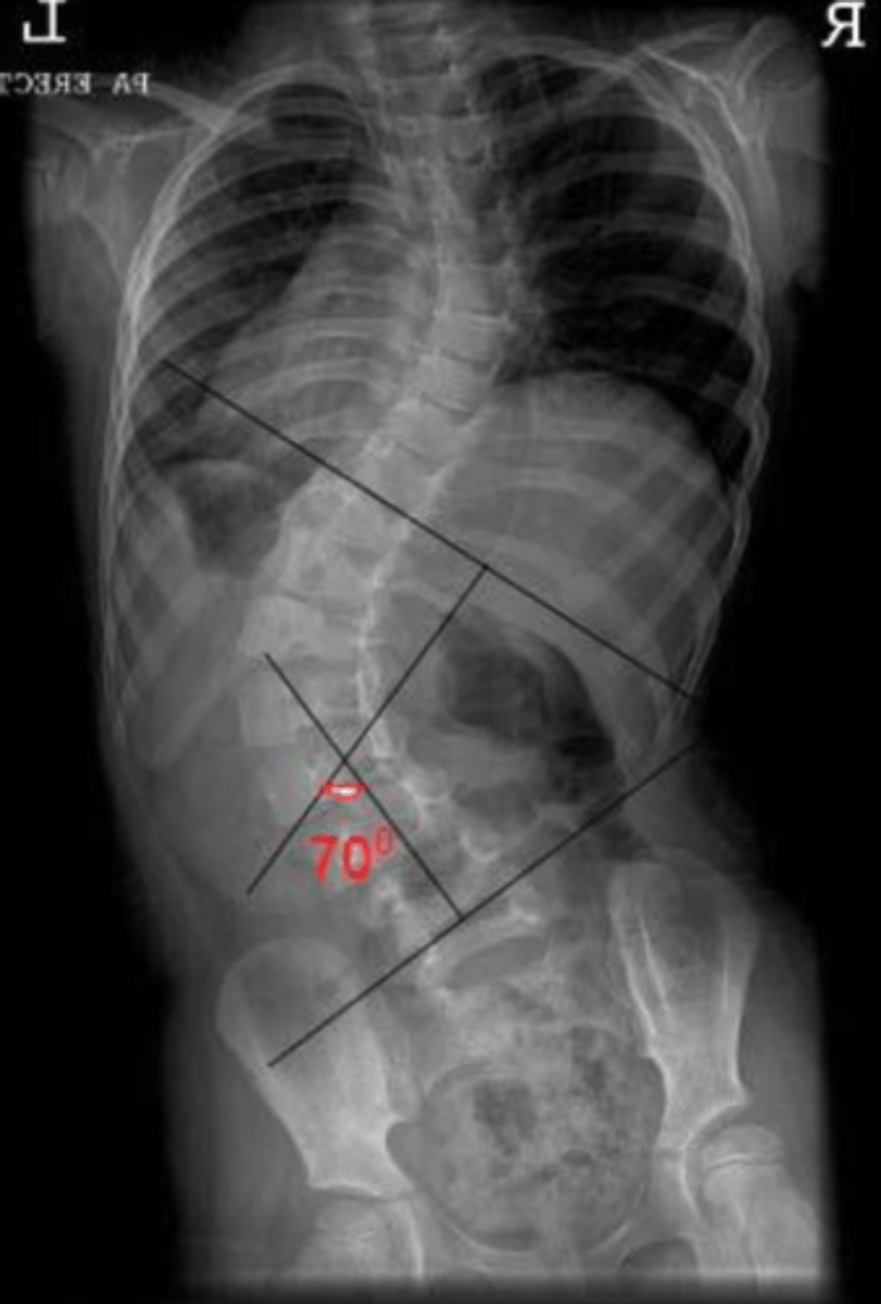 <p>Name the Roentgenometric</p>