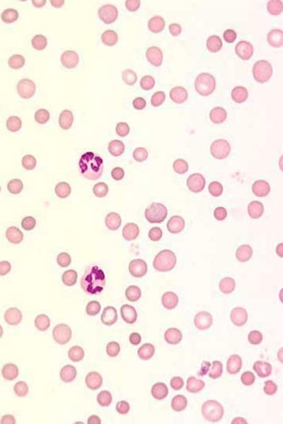 <p>immune destruction of autologous (self) red cells</p>