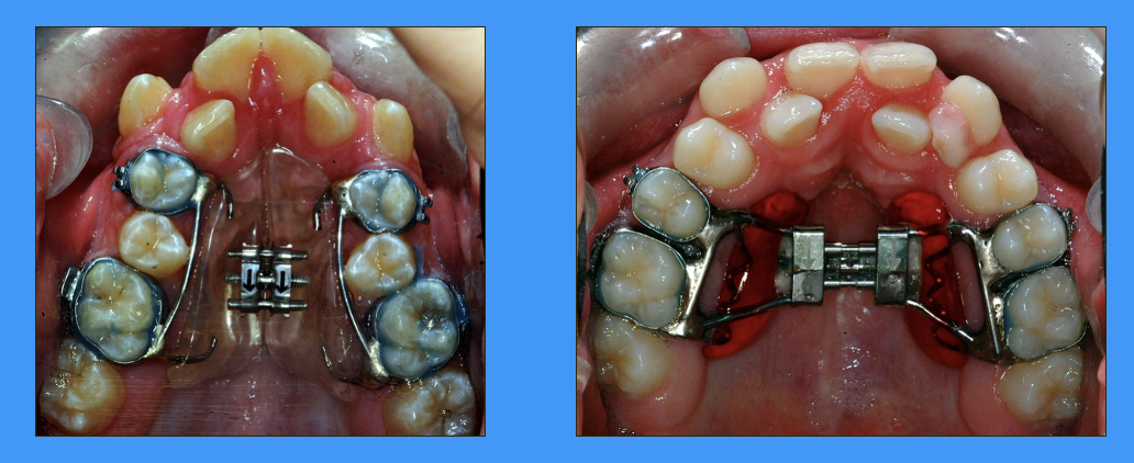 <p>why is knowledge of the growth pattern of the maxilla relevant to dentistry </p>