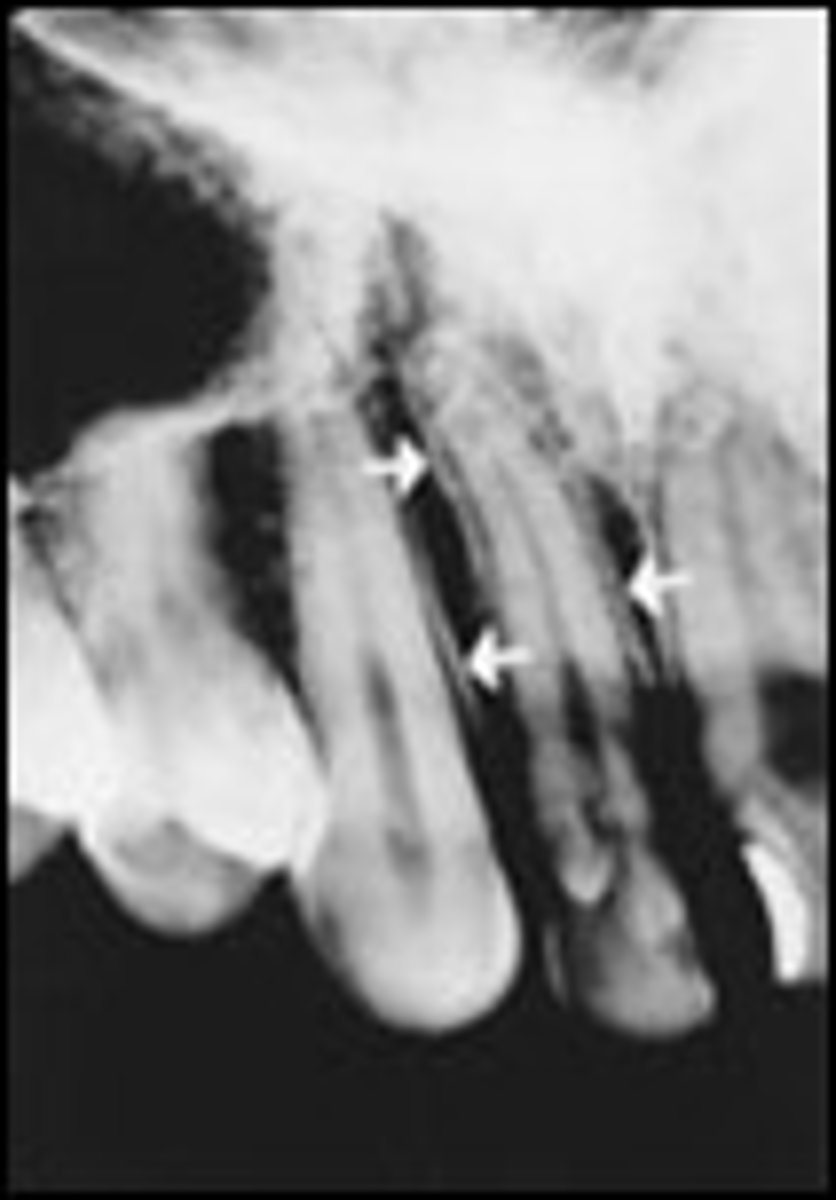 <p>What is the radiopaque structure seen here?</p>