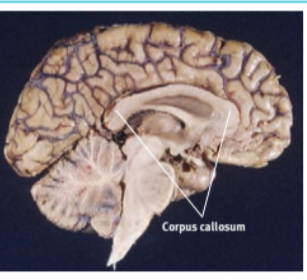 <p>corpus callosum</p>