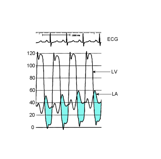 <p>What is being observed a systolic or diastolic gradient</p>