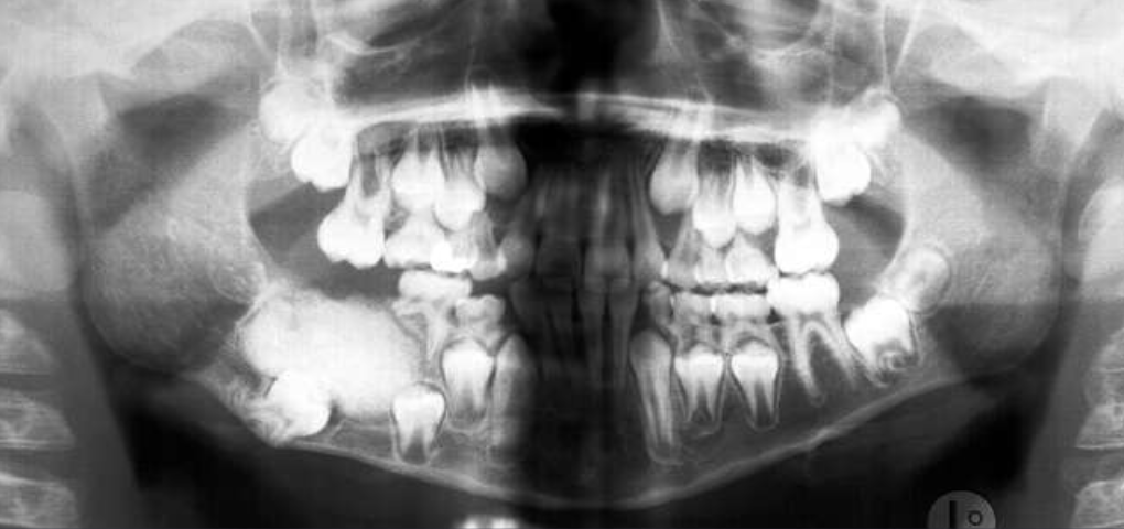<ol><li><p>radio<strong>lucent</strong> band/soft tissue capsule inside the cortical border</p></li><li><p>internal content is largely radi<strong>opaque</strong>- made of irregular mass of calcified tissue</p></li></ol><p></p>