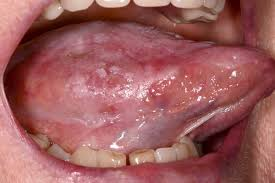 <p>most common→lateral tongue</p><p>back of tongue</p><p>ulceration</p>