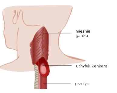 <ul><li><p>najczęstszy uchyłek przełyku</p></li><li><p>Powstaje na skutek relaksacji Górnego zwieracza przełyku</p></li><li><p>Może być przyczyną niedrożności przełyku</p></li><li><p>Może być przyczyną z. Mendelsona</p></li><li><p>Duży uchyłek może powodować chrypkę</p></li></ul>