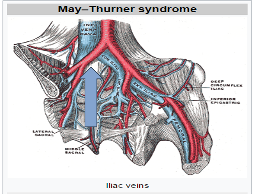 <p>Iliac Vein Compression Syndrome (3)</p>