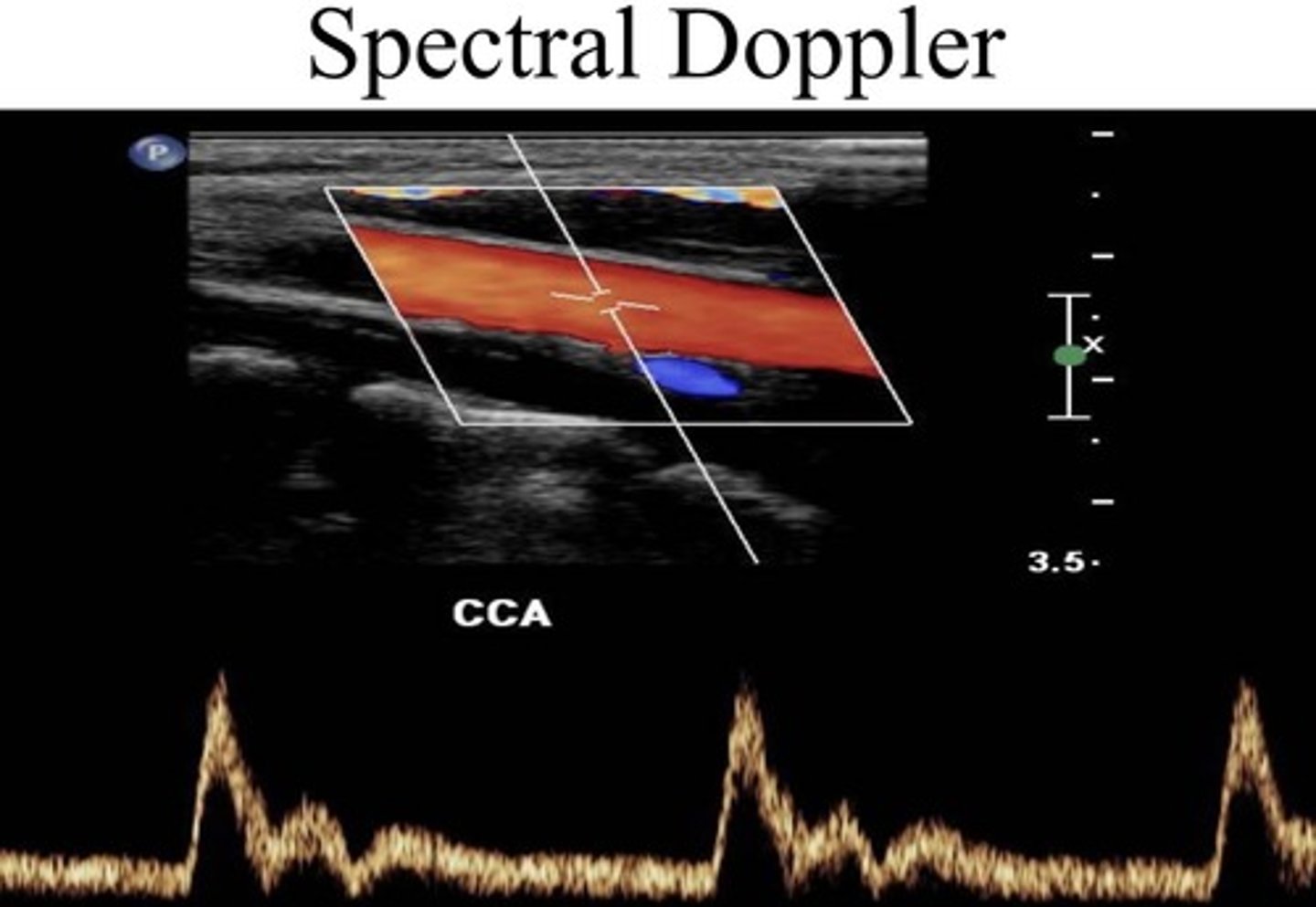 <p>Consist of a continuous and pulsed wave form shows the velocity of moving RBC's. Shown to us as a spectral waveform. Uses a 1D graph</p><p>shows us the velocity of the blood flow moving through the vessels</p>