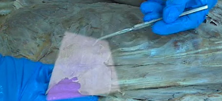 <p>A muscle that originates on the spinous process of lumbar vertebrae, inserts on the lower ribs, and functions to depress the ribs.</p>