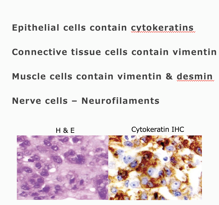 <p>Brown color = presence of cytokeratin = epithelial tumor → carcinoma</p>