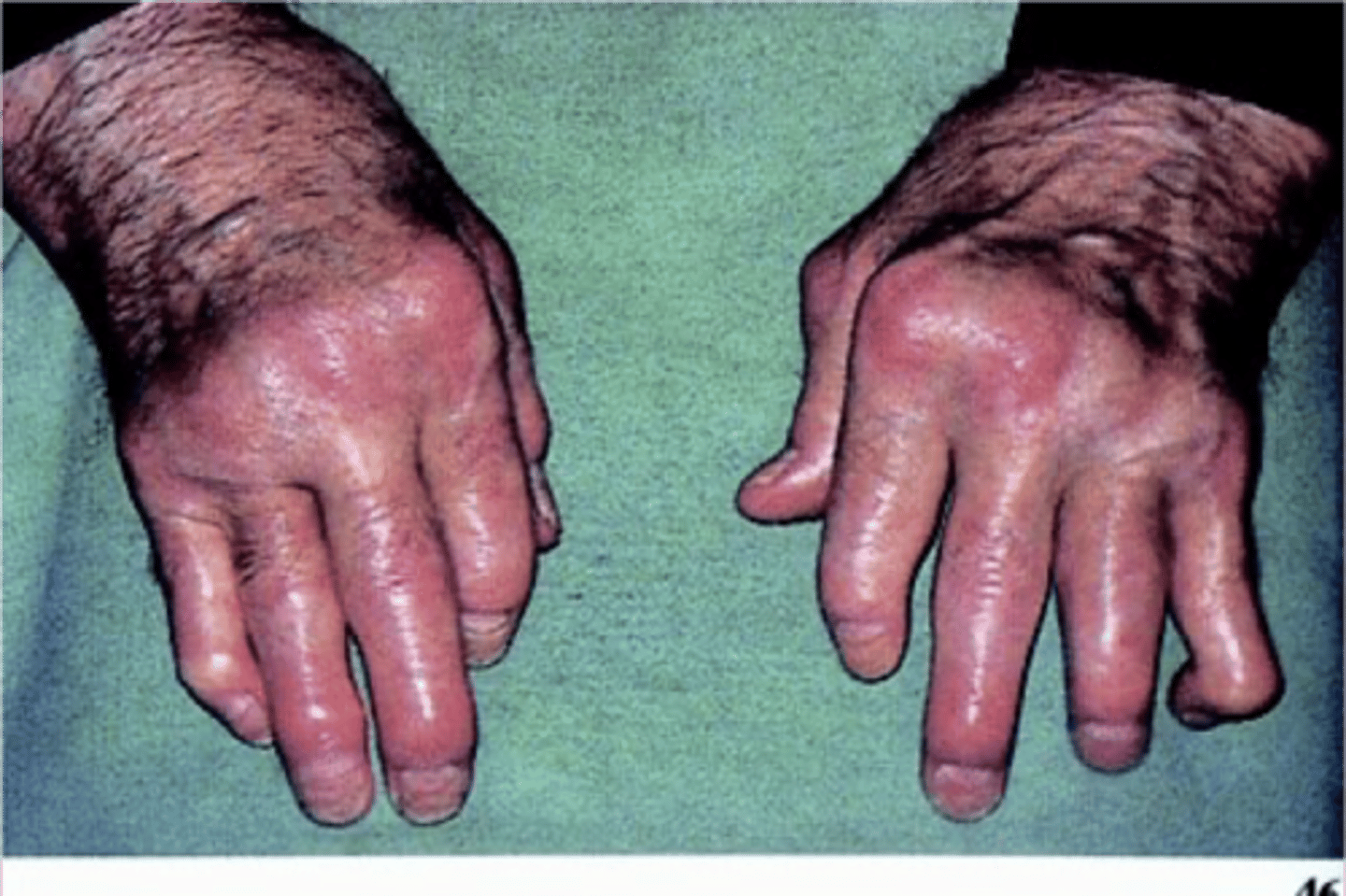 <p>thickening of fingers-sausage fingers, edematous- important to take rings off so they don't have to be cut off</p>