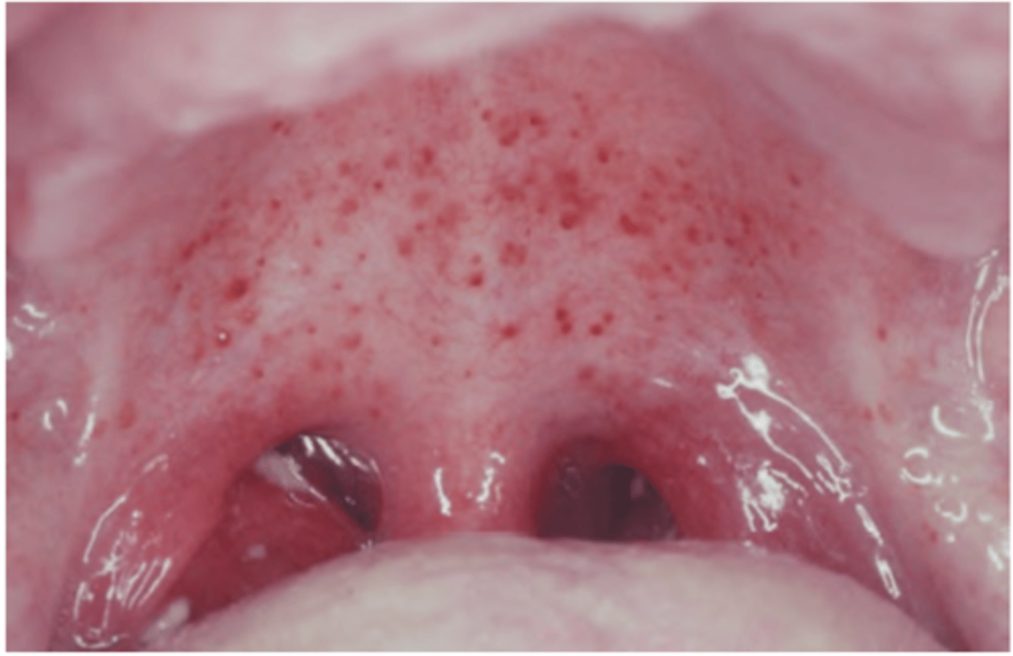 <p>Hint: Petechiae on hard or soft palate</p>