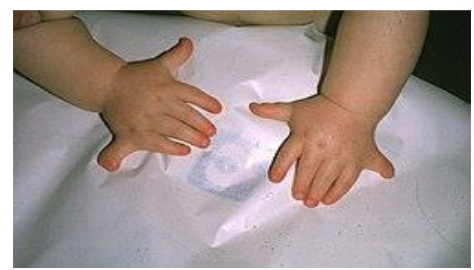 <ul><li><p>Ellis-van Creveld syndrome in the Old Order Amish in Pennsylvania, USA</p></li><li><p>Rare RECESSIVE allele, carried by one of the 200 founders of the community in the 1700’s </p></li><li><p>Community members mostly married one another</p></li><li><p>Symptoms can include POLYDACTYLY, other skeletal anomalies </p></li><li><p>1/5000 Amish births vs 7/1000000 births in the general population </p></li></ul><p></p>