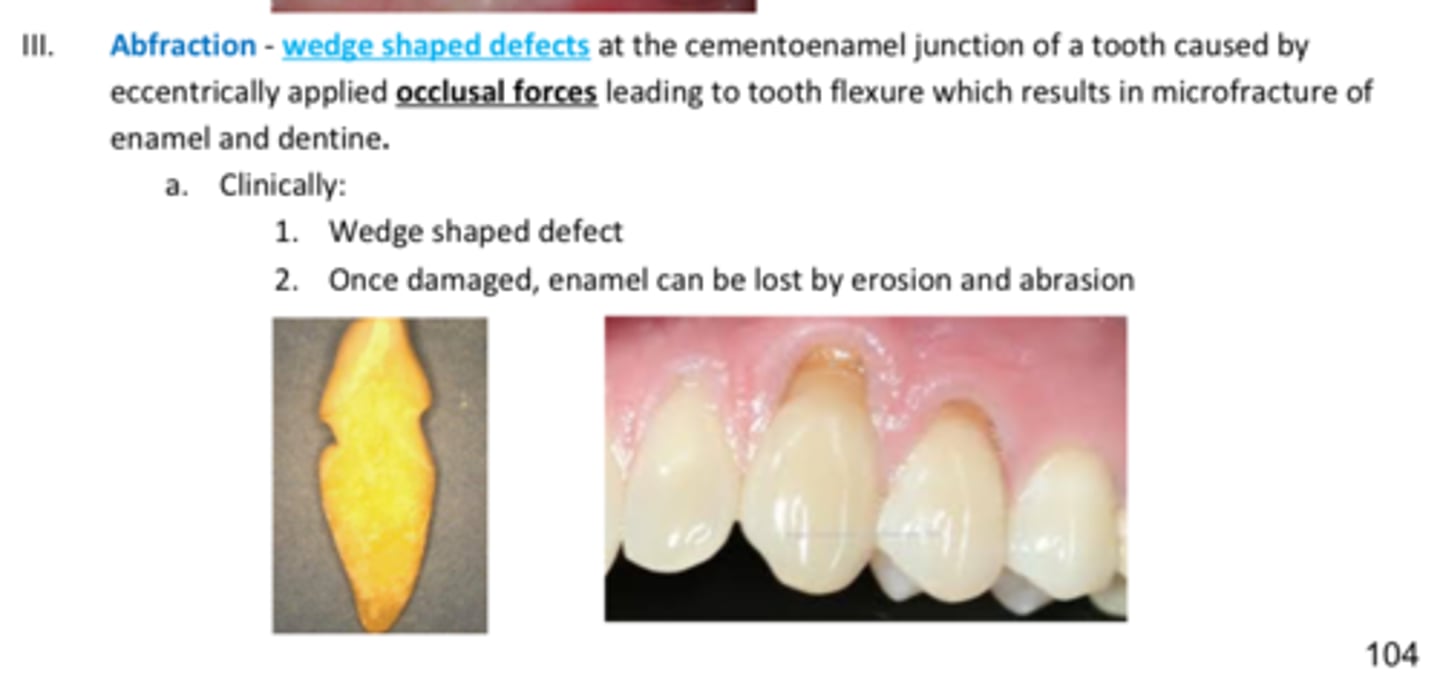 <p>Wedge shaped defects at the cementoenamel junction of a tooth caused by eccentrically applied occlusal forces leading to tooth flexure which results in microfracture of enamel and dentine.</p><p>Clinically:</p><p>Wedge shaped defect</p><p>Once damaged, enamel can be lost by erosion and abrasion</p>