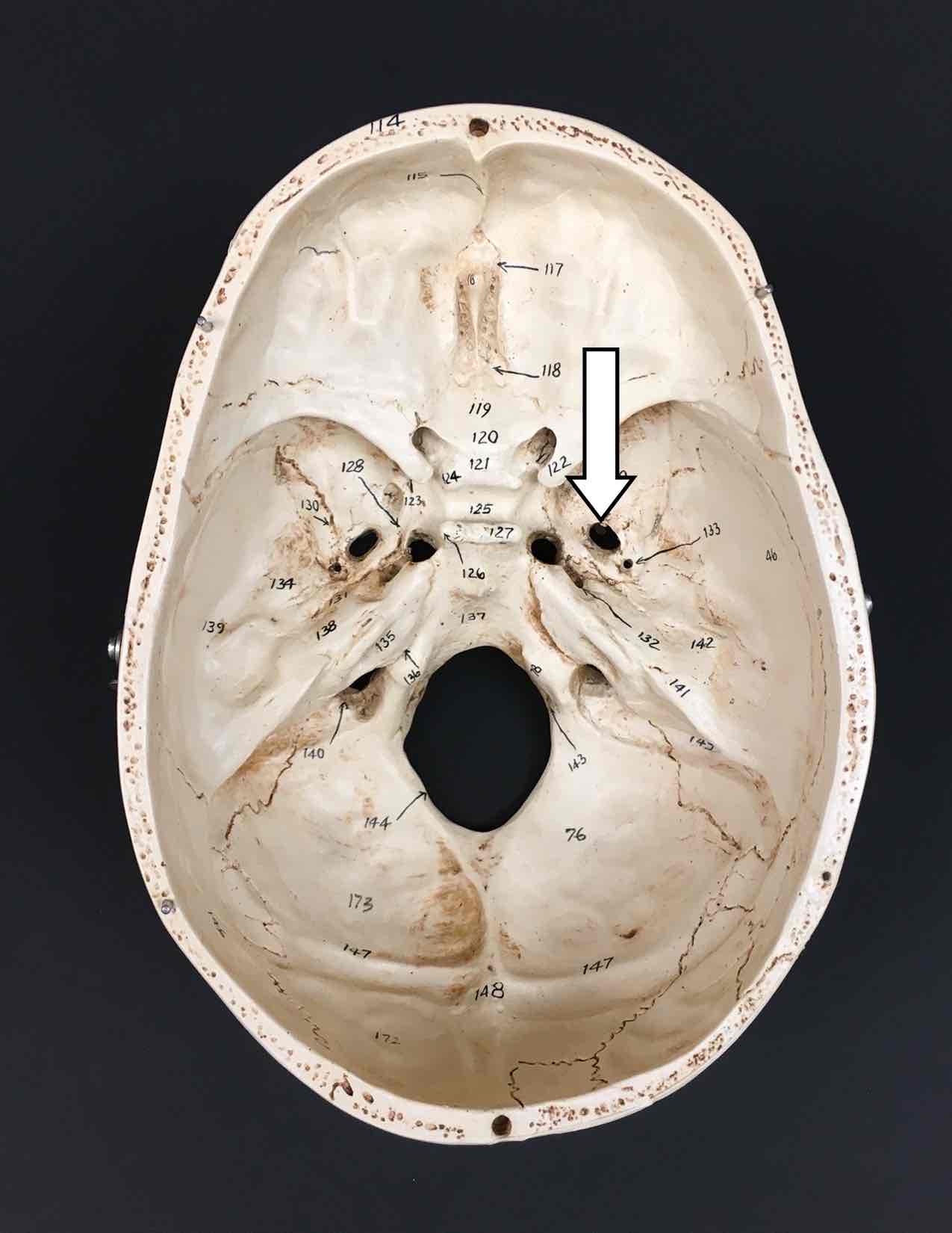 <p>Name one cranial nerve that passes through this hole and its roman numeral</p>