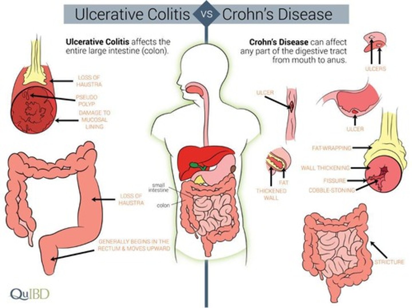 <p>Crohn's disease (CD) and Ulcerative colitis (UC).</p>